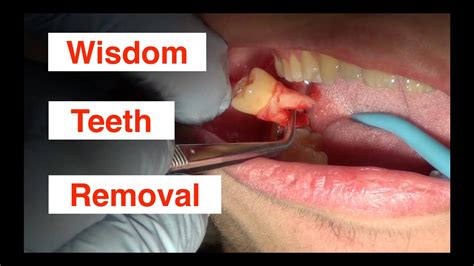 Showering After Wisdom Tooth Removal: What You Need To Know